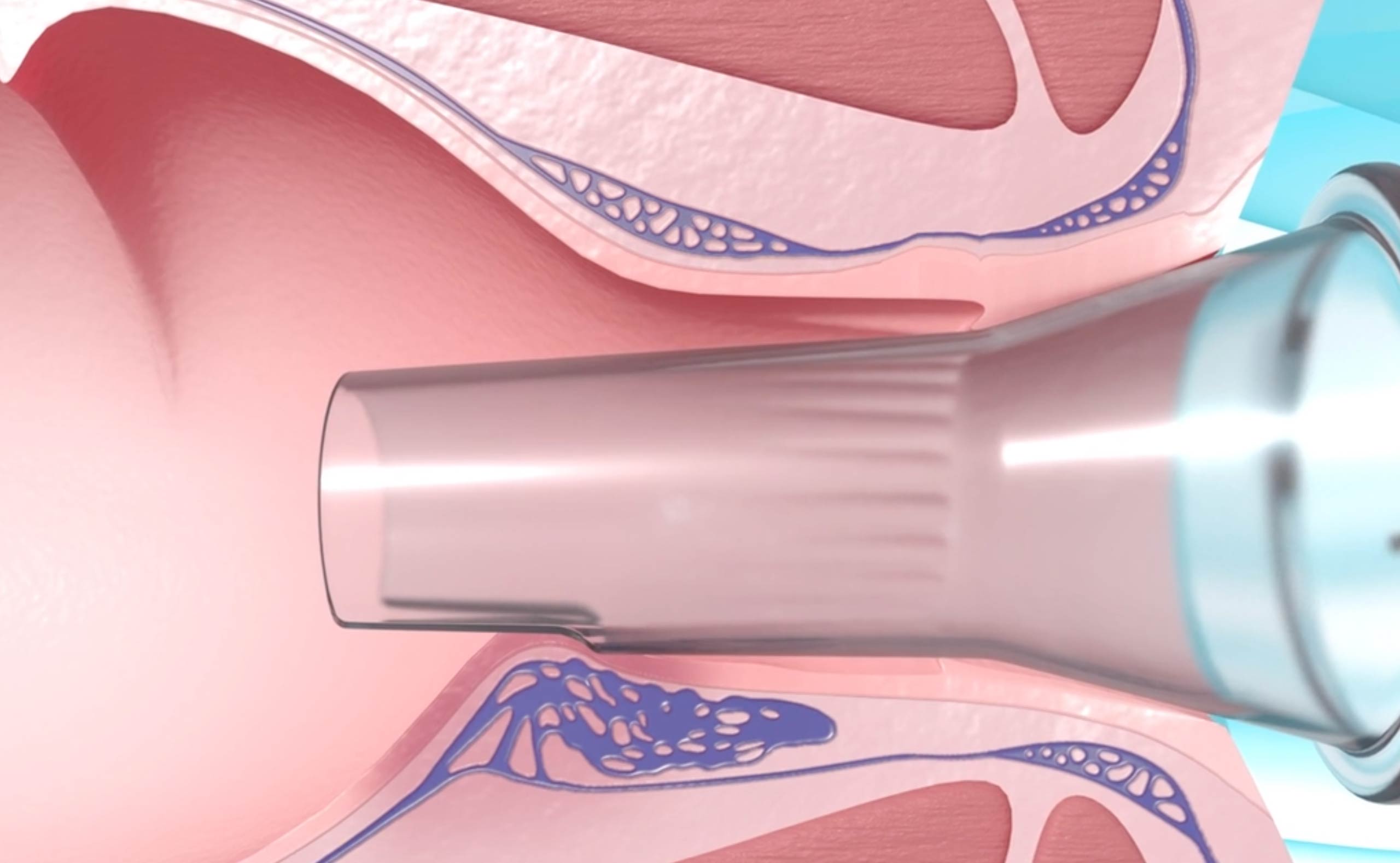 Internal Hemorrhoids Treatment Nhs
